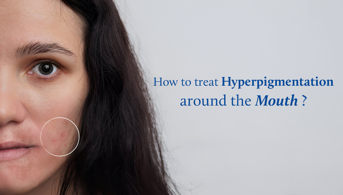 Hyperpigmentation