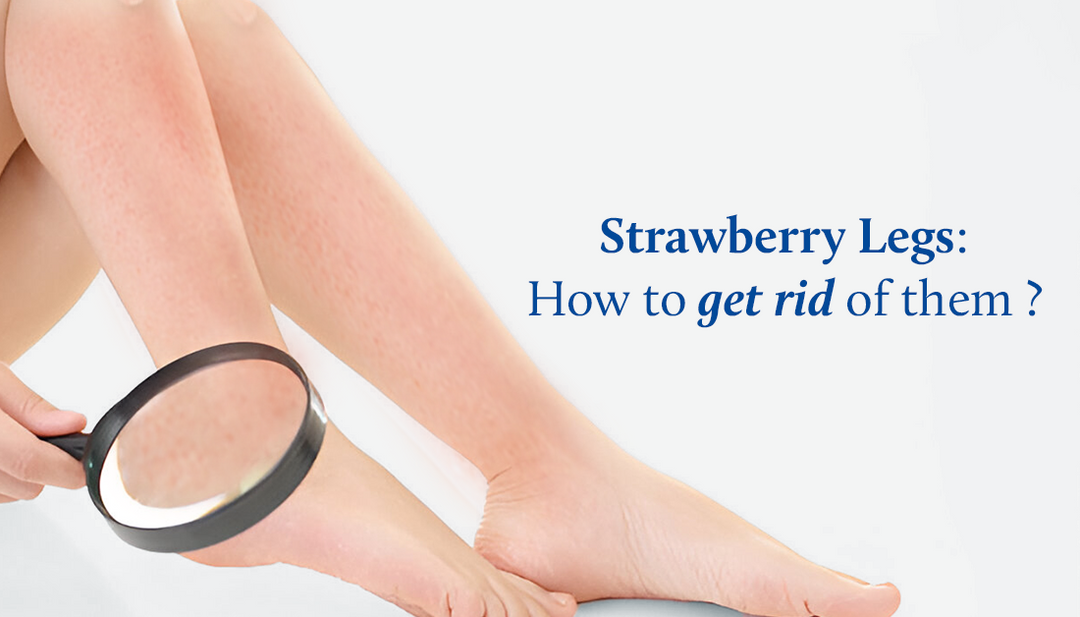 Strawberry Legs : What it is, Causes, Prevention and Treatment