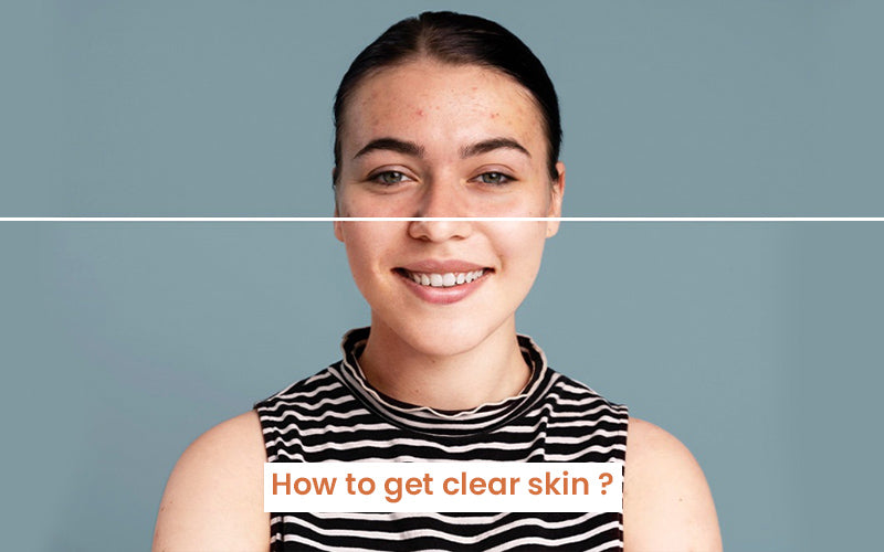 How to get clear skin naturally 