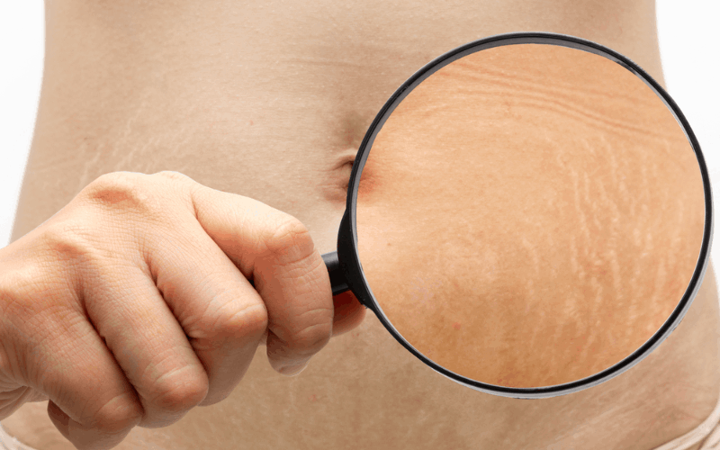 Girl is showing her stretch marks by holding magnifying glass on it