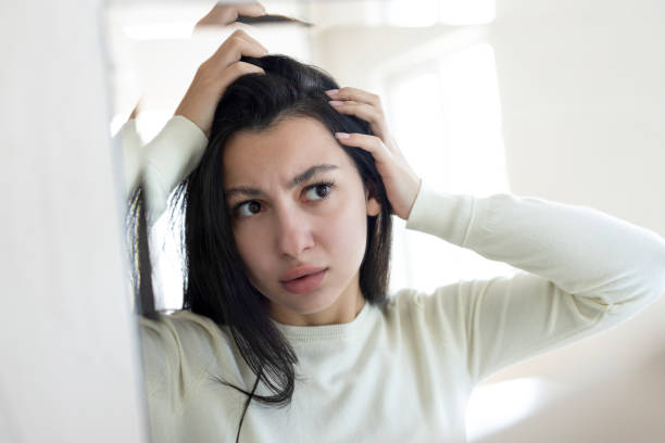 From Hormones to Doshas: Understanding Dandruff the Ayurvedic Way